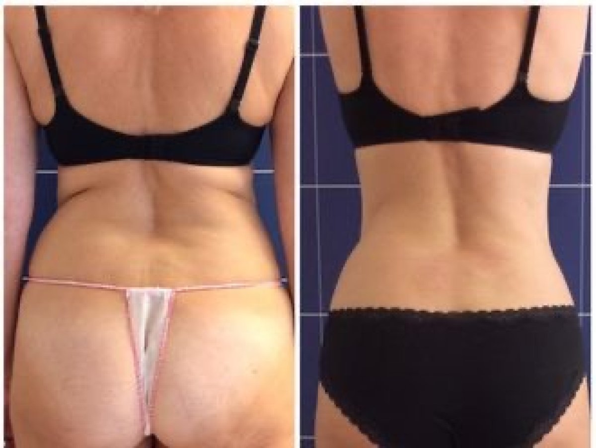 Resultados de liposucción antes y después en LaCLINIQUE of Switzerland, contorno de cintura mejorado