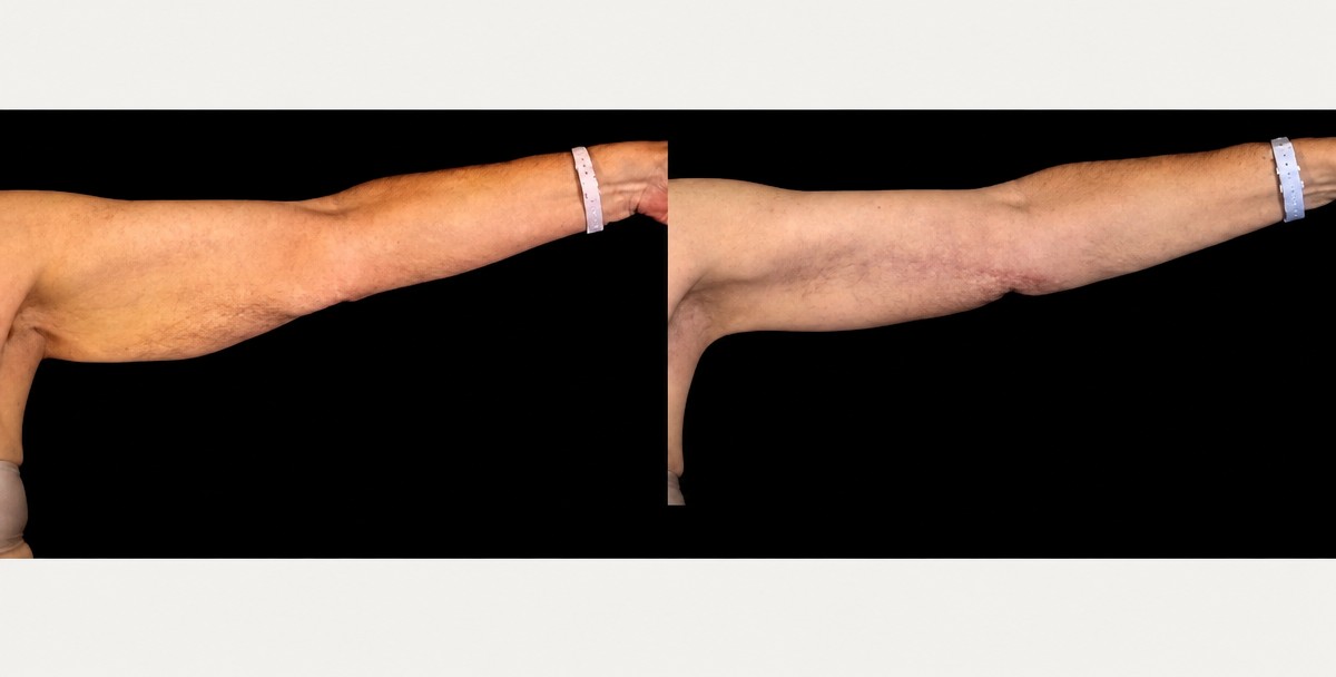 Resultados antes y después de lifting de brazos en LaCLINIQUE of Switzerland, contorno mejorado