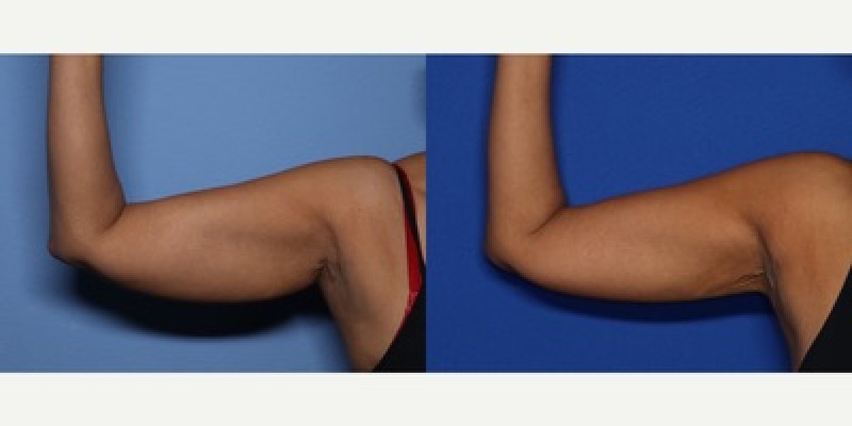 Before and after arm lift results at LaCLINIQUE of Switzerland, improved arm contour