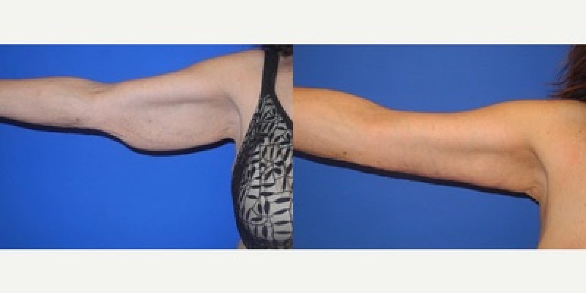 Before and after arm lift results at LaCLINIQUE of Switzerland, improved upper arm contour