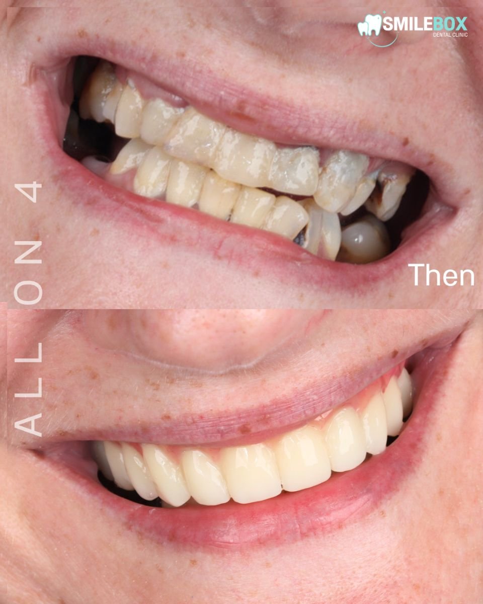 Resultados antes y después de implantes All-on-4 en SmileBox Dental Clinic - sucursal Thonglor