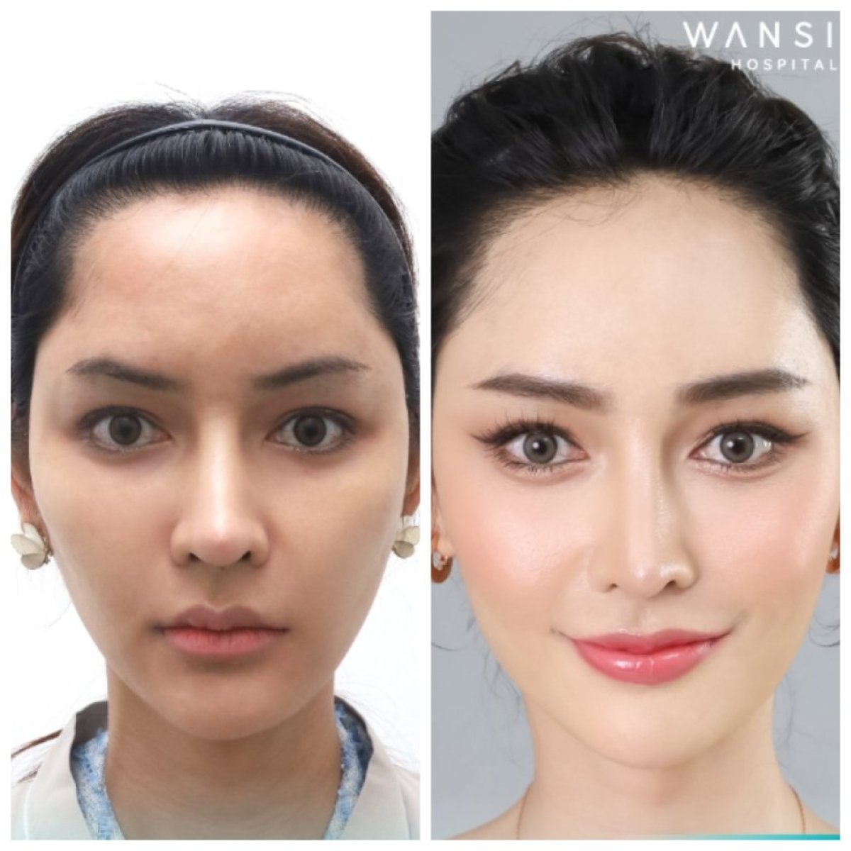 Resultados de cirugía de feminización facial antes y después en Wansiri Hospital, rasgos femeninos