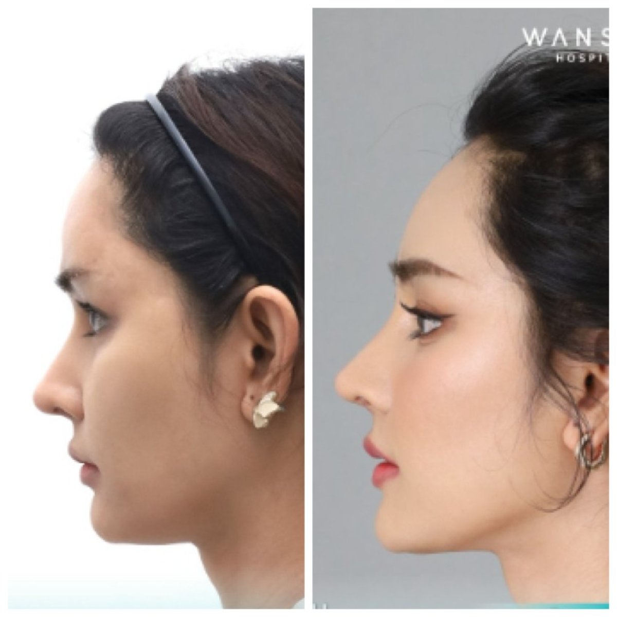 Resultados antes y después de cirugía de feminización facial en Wansiri Hospital, perfil refinado