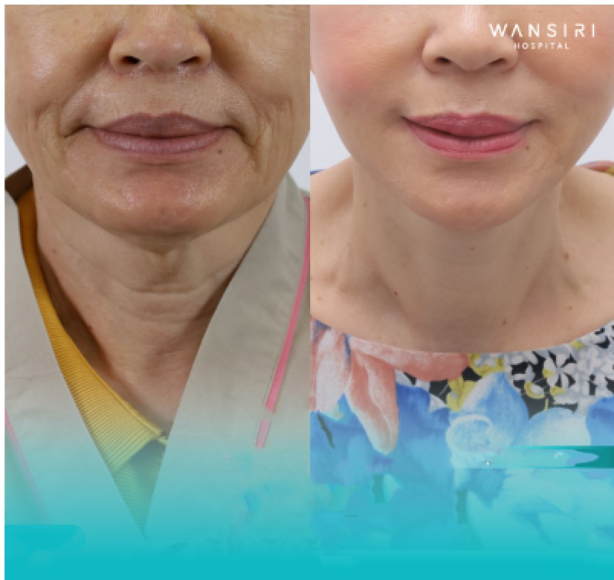 Resultados de lifting de cuello antes y después en Wansiri Hospital, piel más firme y rejuvenecida