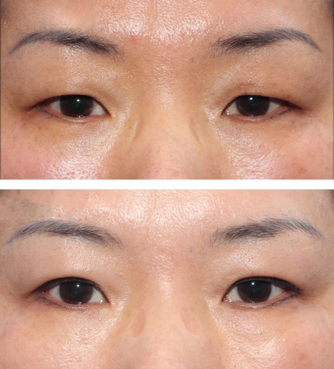 Vorher-nachher-Ergebnis der Blepharoplastik bei HERSHE Plastic Surgery Korea, Lidkorrektur