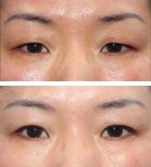 Fotos vor und nach Blepharoplastik (Augenlidkorrektur) durch Dr. 