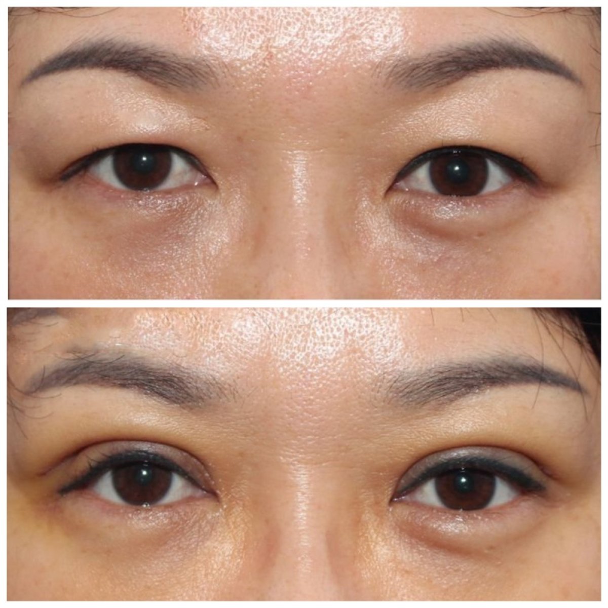 Resultados de blefaroplastia antes y después en HERSHE Plastic Surgery Korea, corrección de párpados
