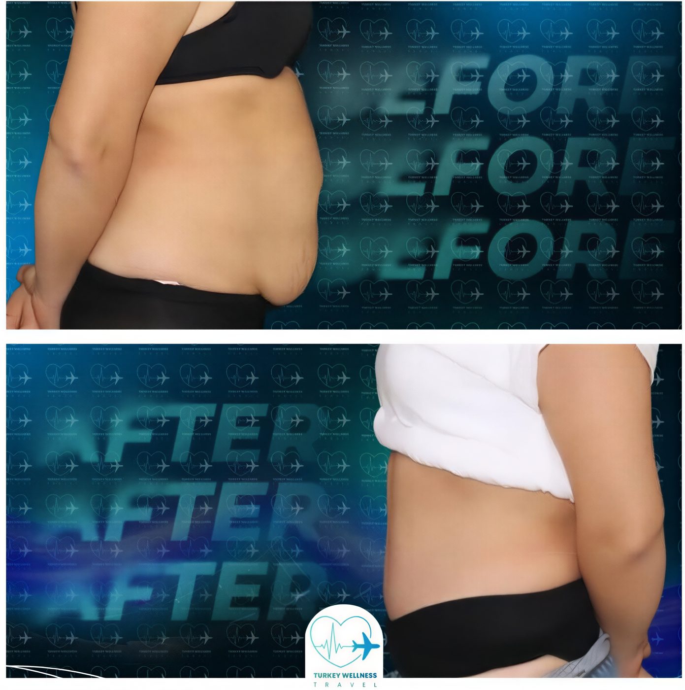 Resultados de liposucción antes y después en TWT Health Clinic, reducción visible de grasa abdominal