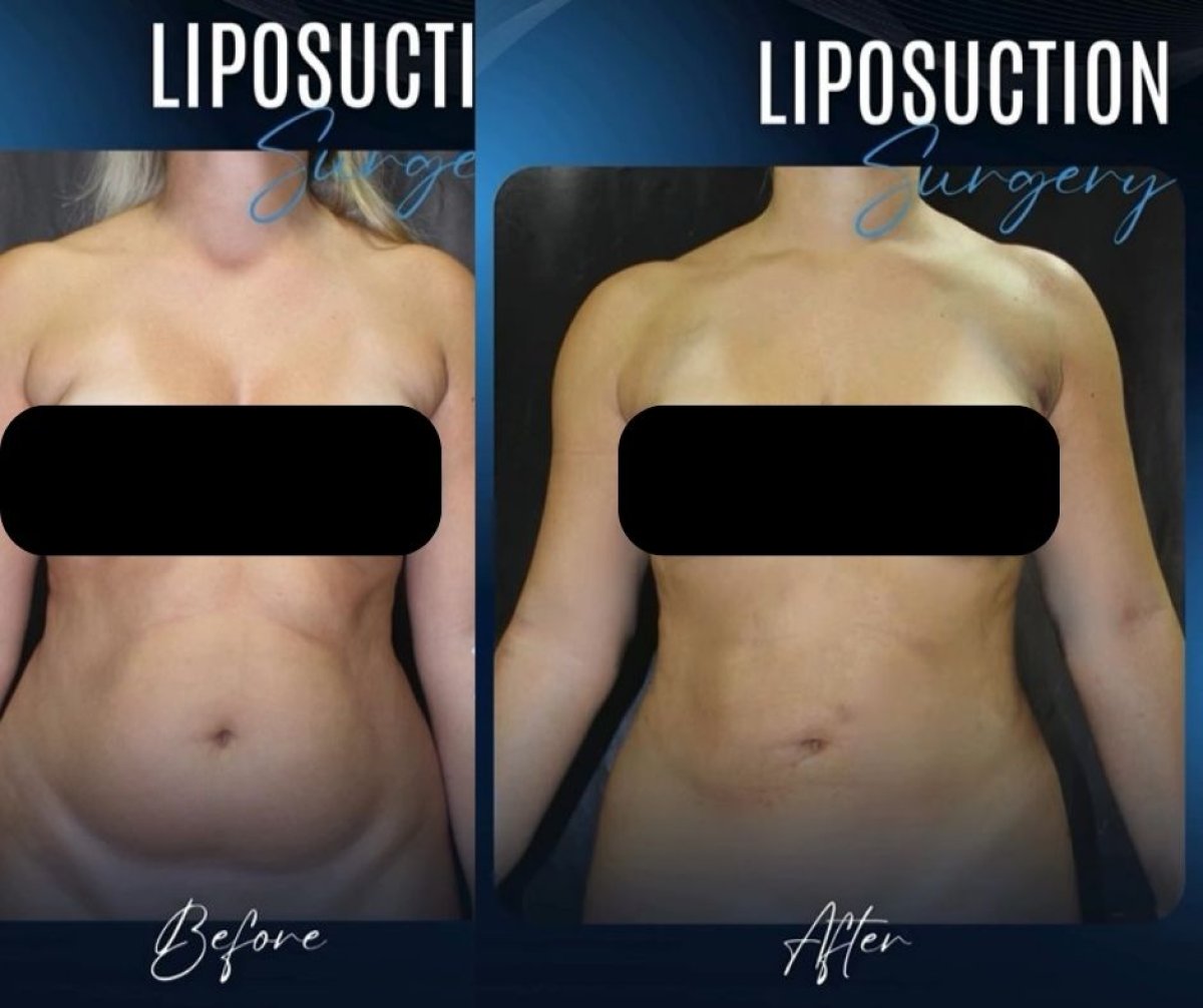 Vorher-nachher-Liposuktionsergebnis bei TWT Health Clinic – sichtbare Körperkontur