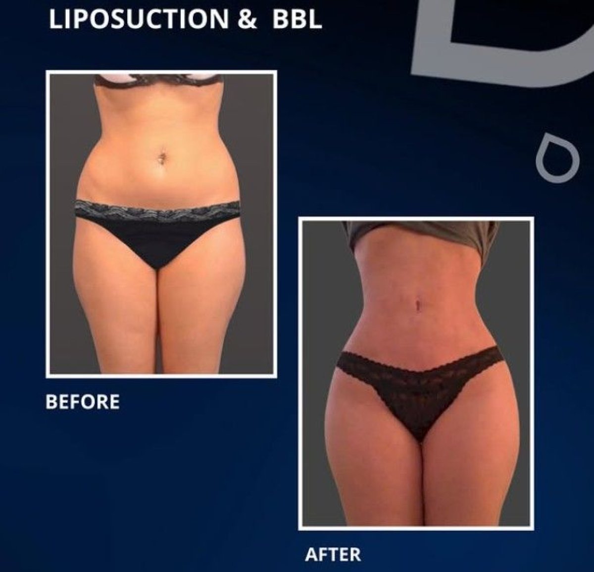 Vorher-nachher-Ergebnis Liposuktion und BBL bei TWT Health Clinic, verbesserte Silhouette