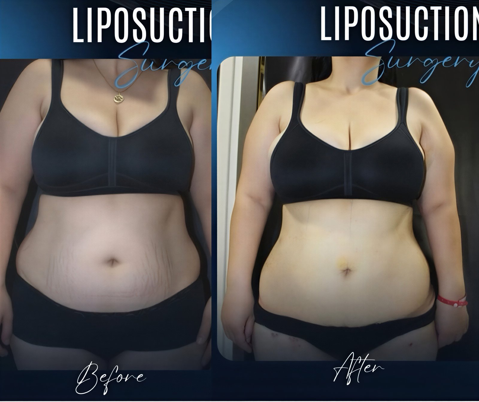 Resultados de liposucción antes y después en TWT Health Clinic, mejora visible del abdomen