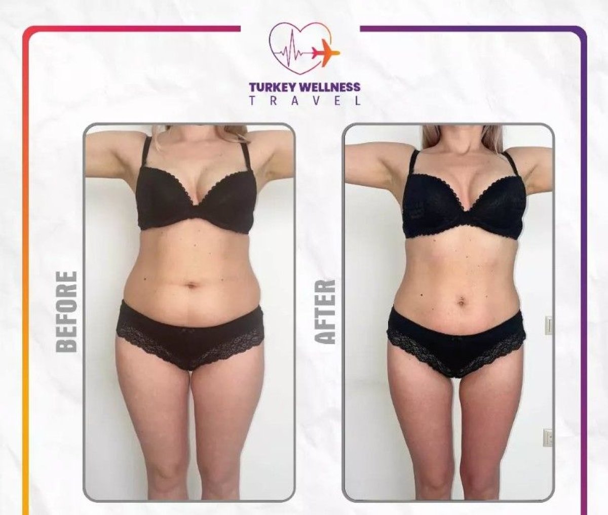 Before and after liposuction results at TWT Health Clinic, visible body contour improvement