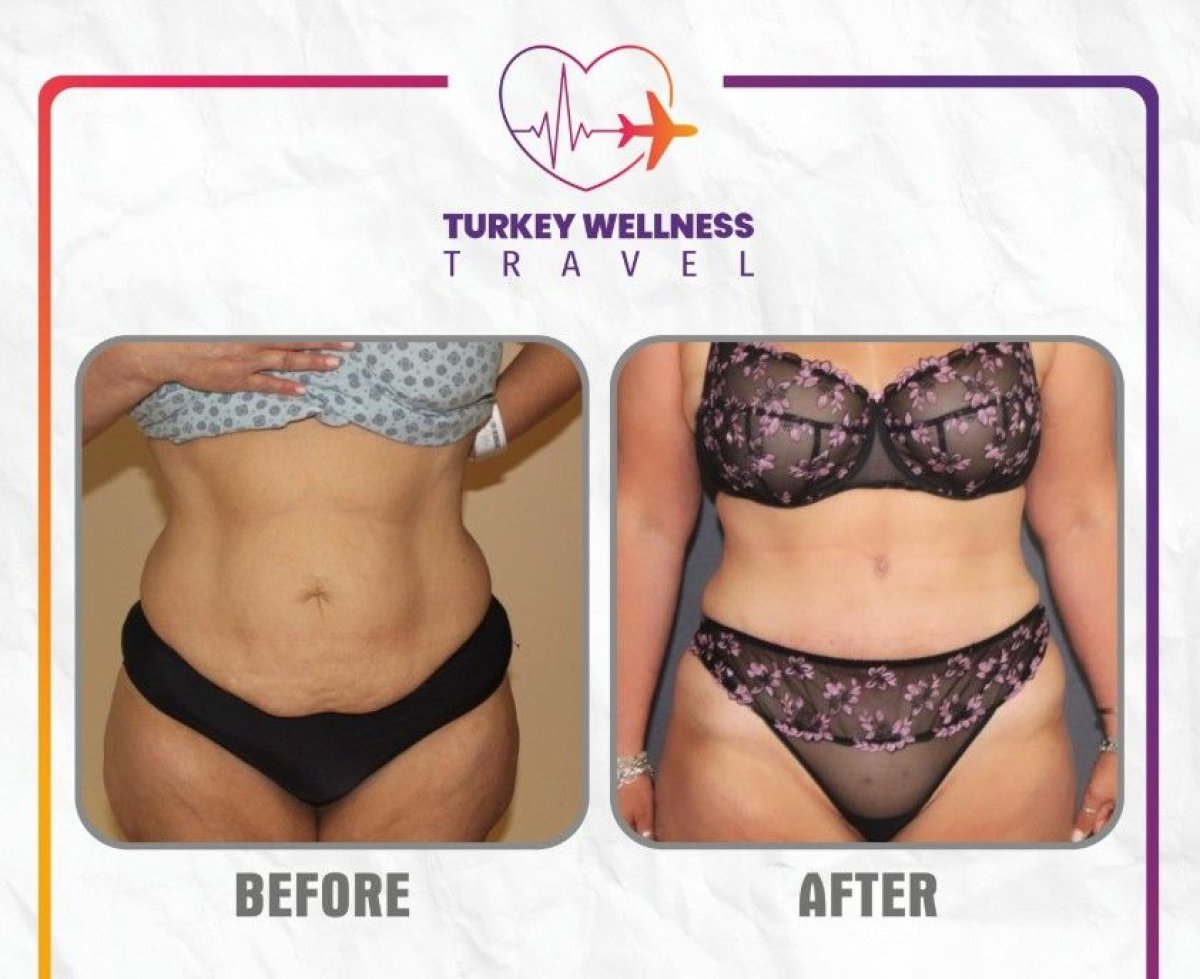 Resultados de liposucción antes y después en TWT Health Clinic, mejora visible del contorno corporal