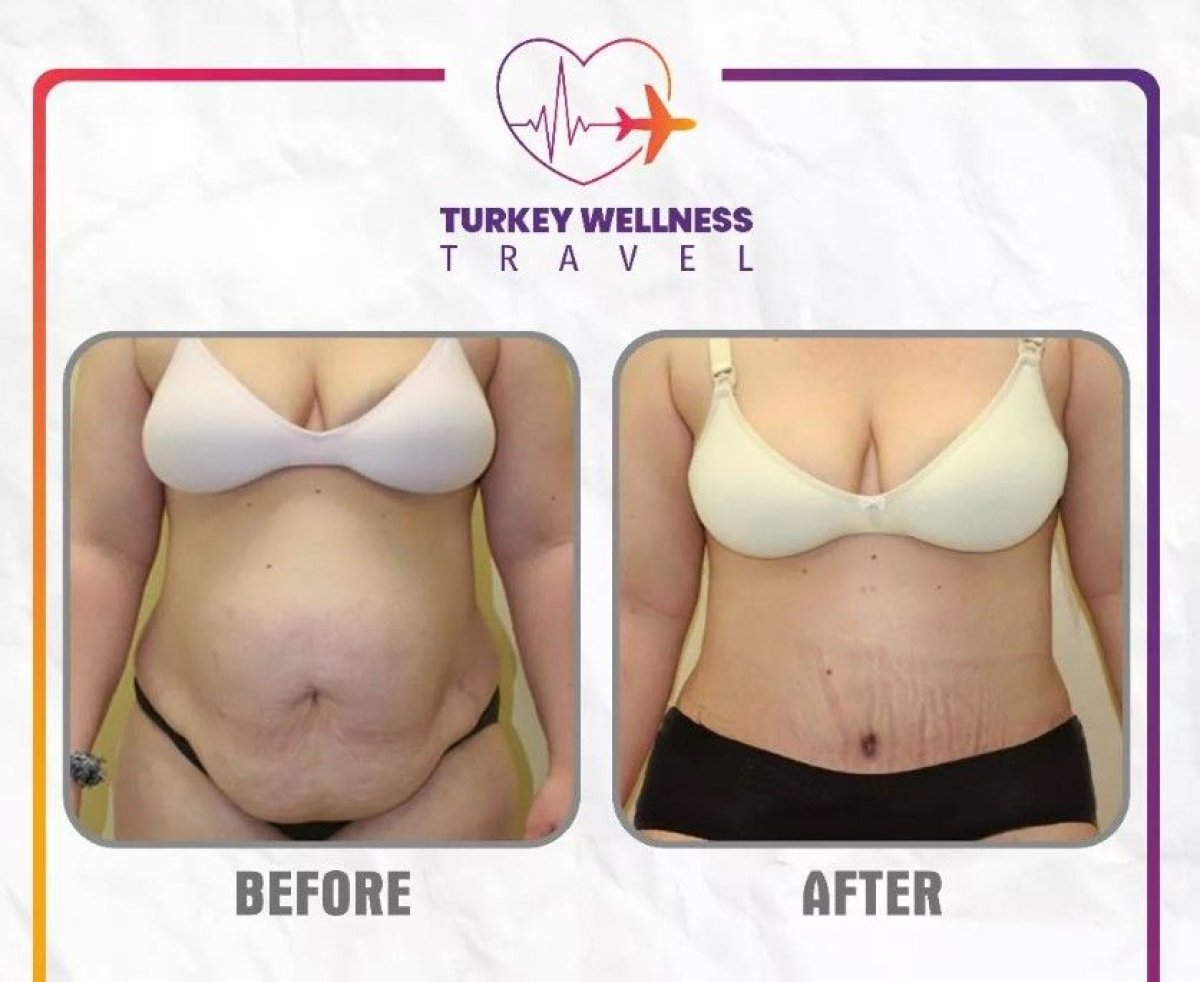 Before and after liposuction results at TWT Health Clinic, visible abdominal contour improvement