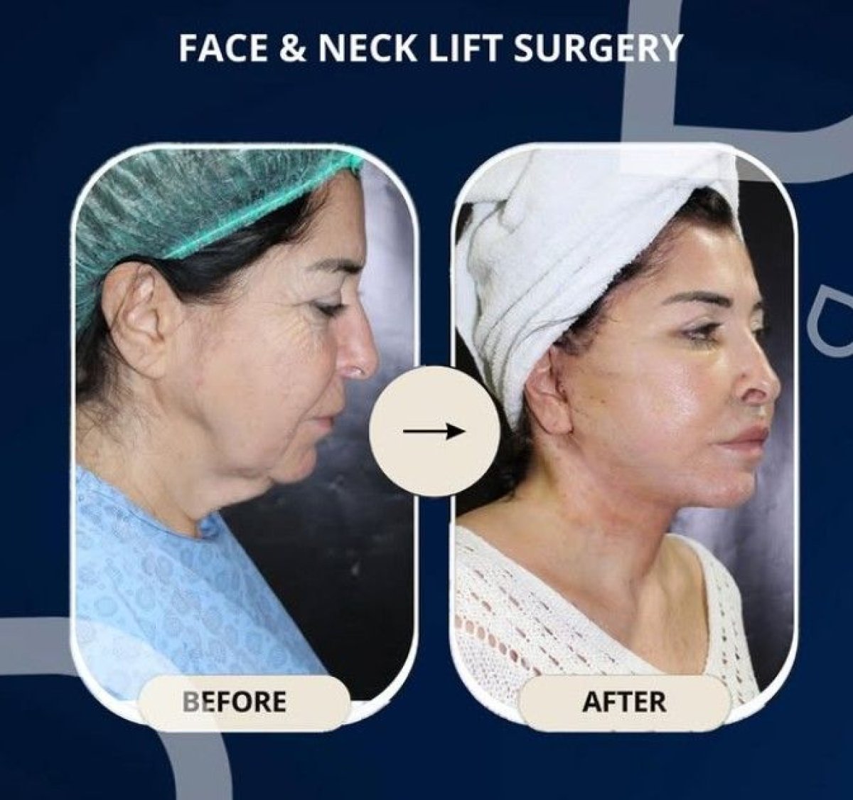 Resultados antes y después de lifting facial y de cuello en TWT Health Clinic, rejuvenecimiento visible