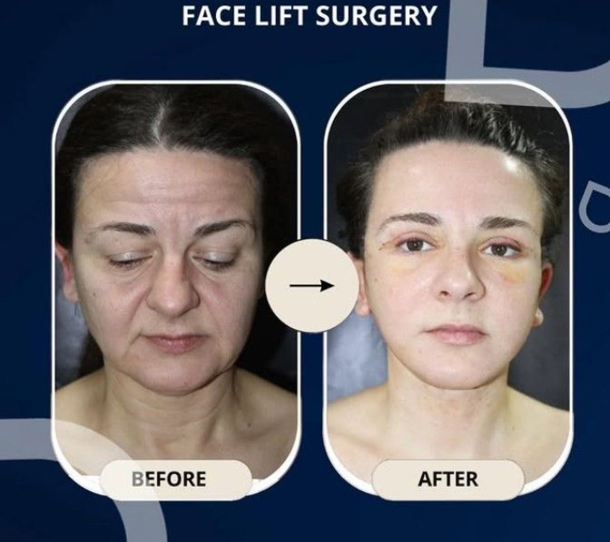 Resultados de lifting facial antes y después en TWT Health Clinic, rejuvenecimiento visible
