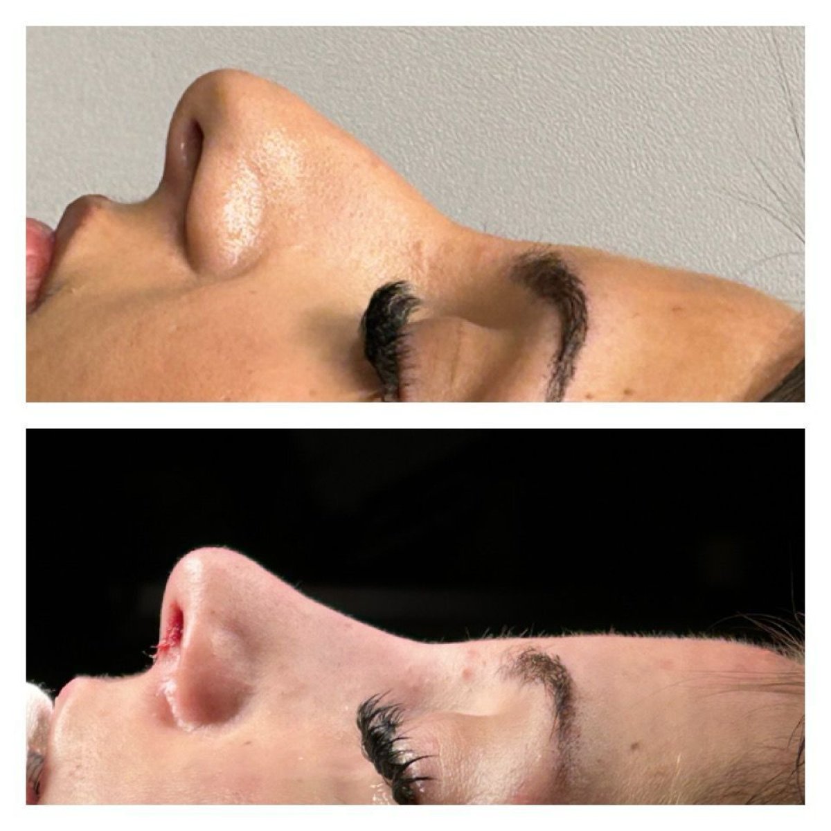 Before and after revision rhinoplasty results at Memorial Şişli Hospital, nose reshaping
