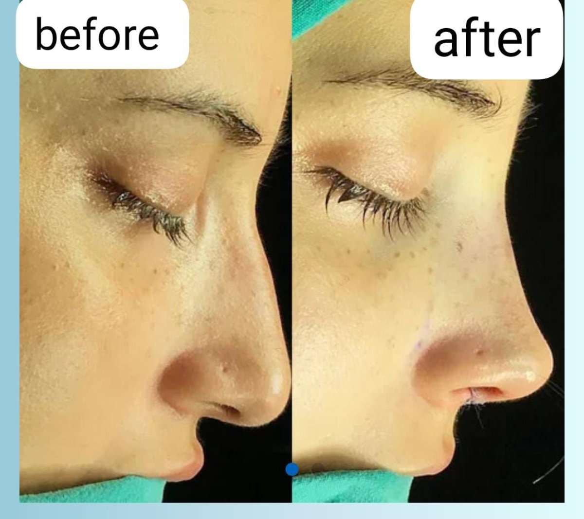 Resultado antes y después de rinoplastia secundaria en Memorial Şişli Hospital, forma de nariz mejorada