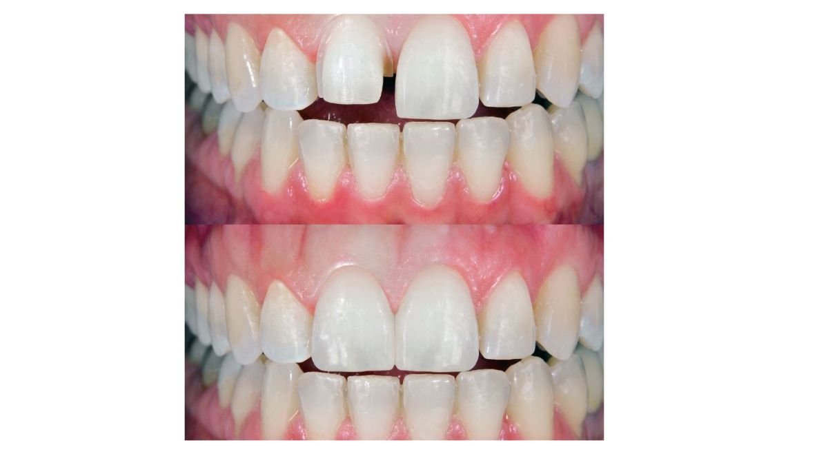 Resultados antes y después de carillas de porcelana en Smile Centrum: dientes alineados y blancos