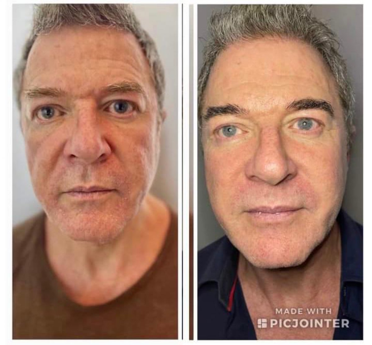 Before and after nonsurgical facelift result at Reju Stem Cell Clinic, facial rejuvenation