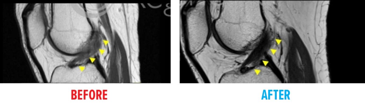 Before and after stem cell therapy result for knee joint at Reviv clínica, MRI comparison