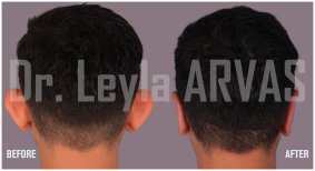 Before and after Otoplasty (ear surgery) photos by Dr. 