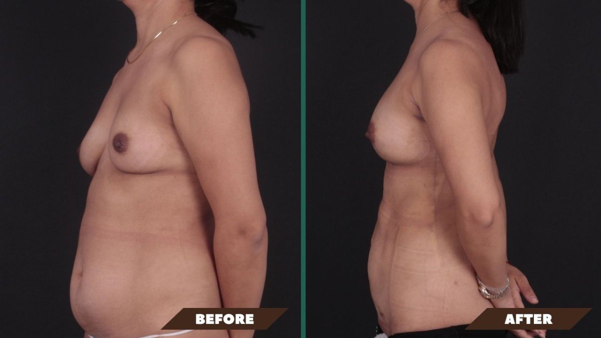 Before and after breast augmentation with fat transfer at Quartz Hospital, visible contour result