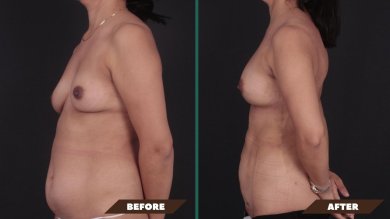 Premium Breast Augmentation with Fat Transfer All Included - photo 4