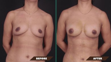 Premium Breast Augmentation with Fat Transfer All Included - photo 5