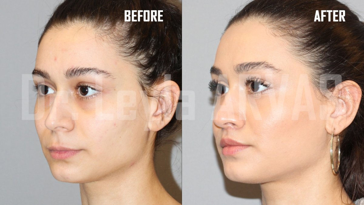 Before and after lip lift results at Quartz Hospital, enhanced upper lip contour and shape