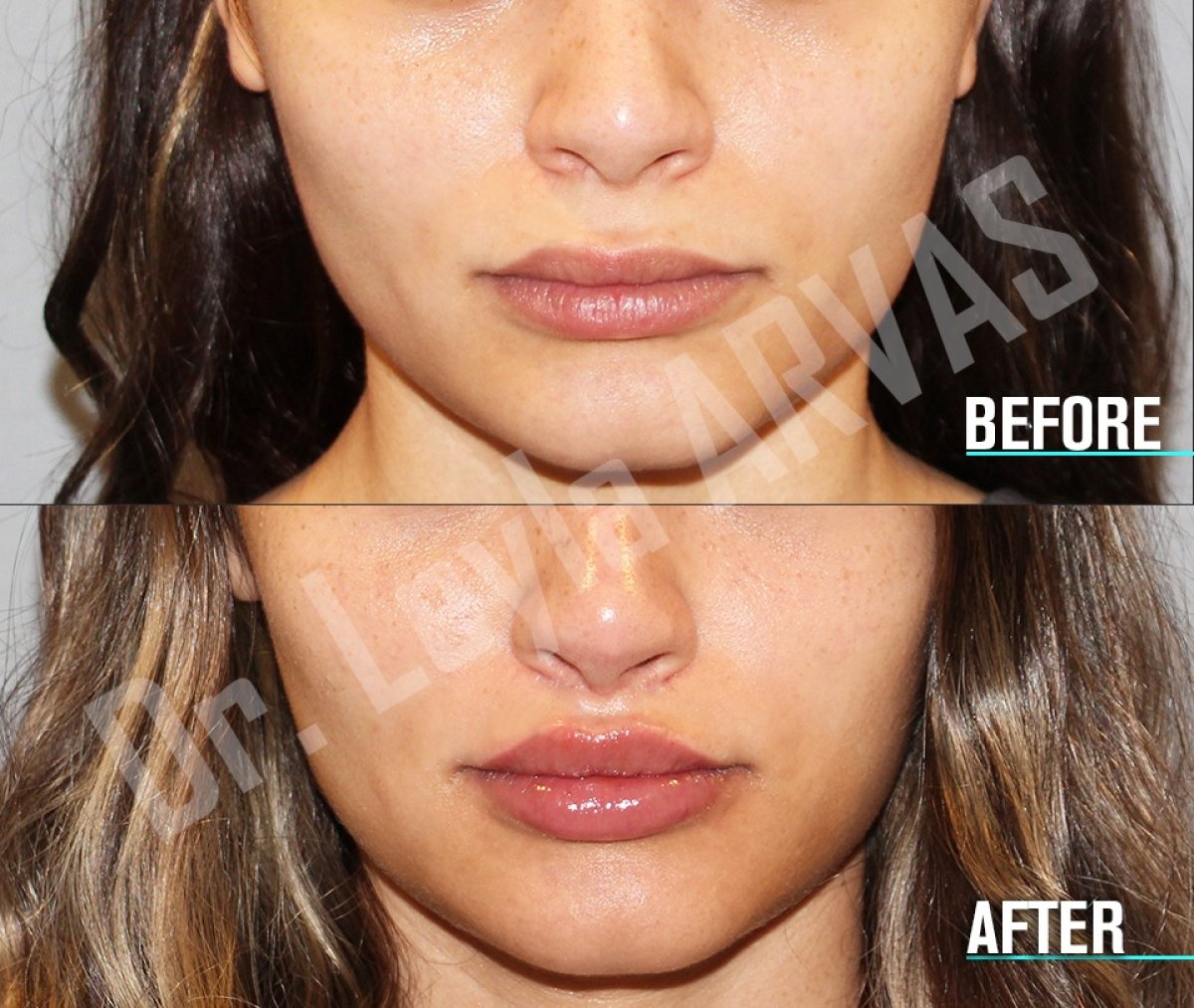Before and after lip lift results at Quartz Hospital, enhanced upper lip contour and volume