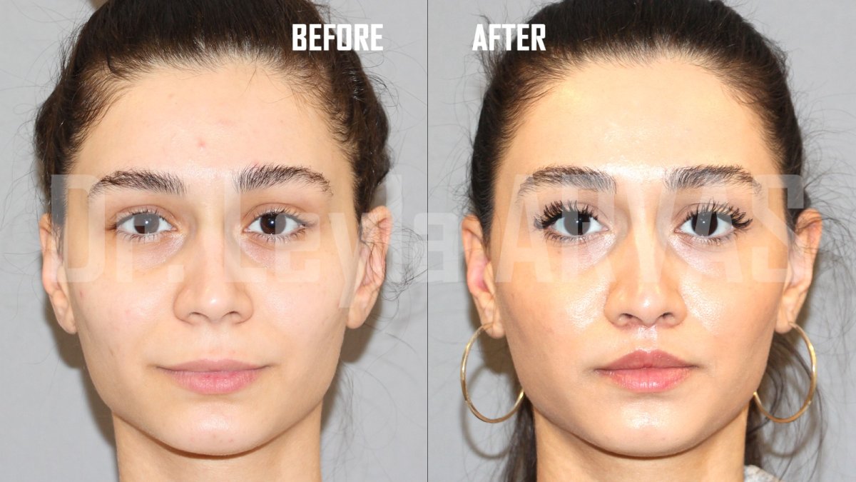 Before and after lip lift results at Quartz Hospital, enhanced upper lip contour and shape