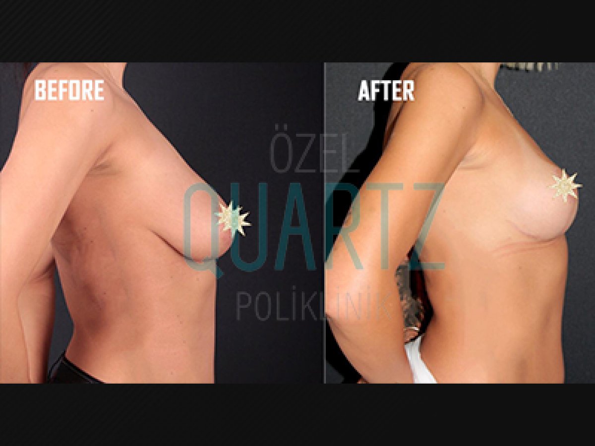 Before and after breast implants with lift at Quartz Hospital – enhanced breast contour result
