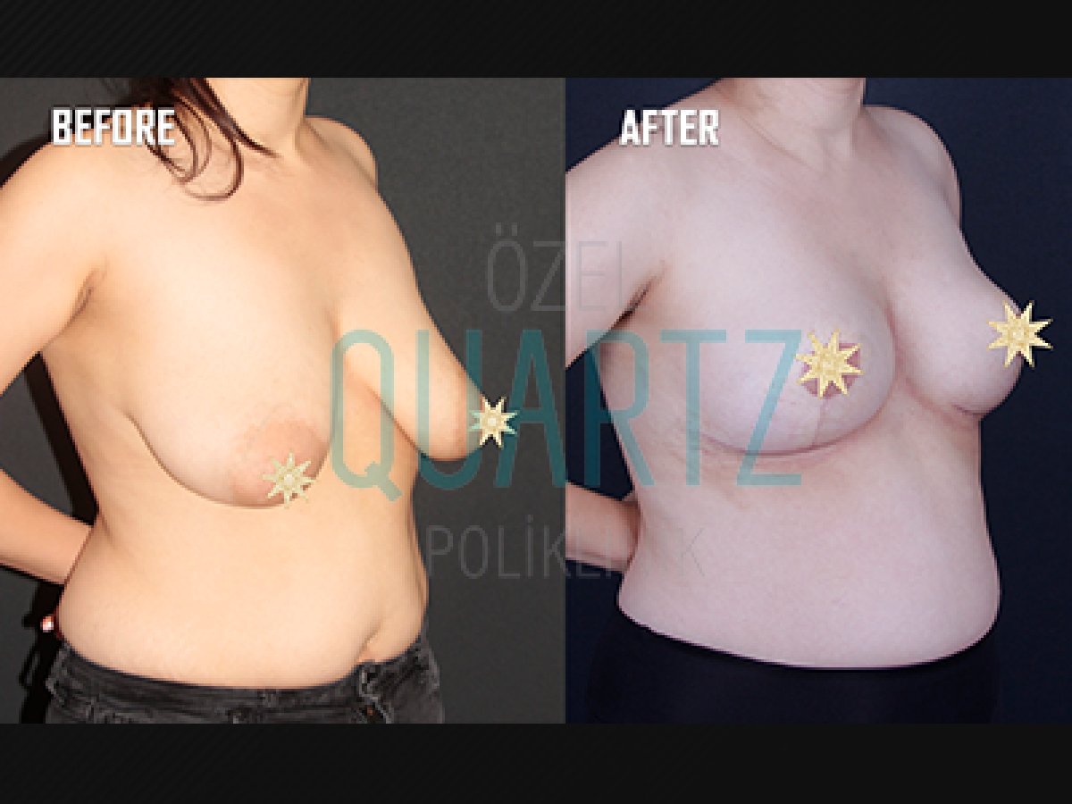 Before and after breast implants with lift results at Quartz Hospital, enhanced breast shape