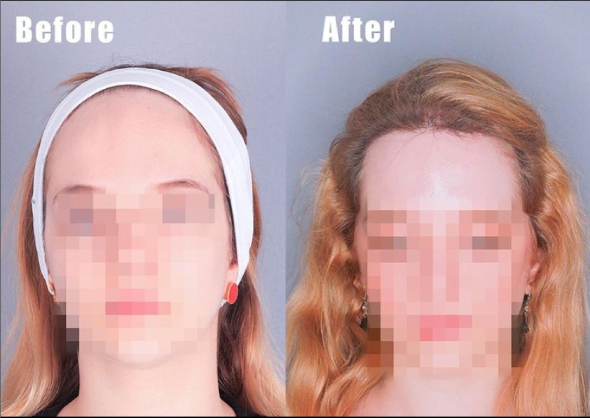 Before and after hair transplant results at Quartz Hospital, improved female hairline restoration