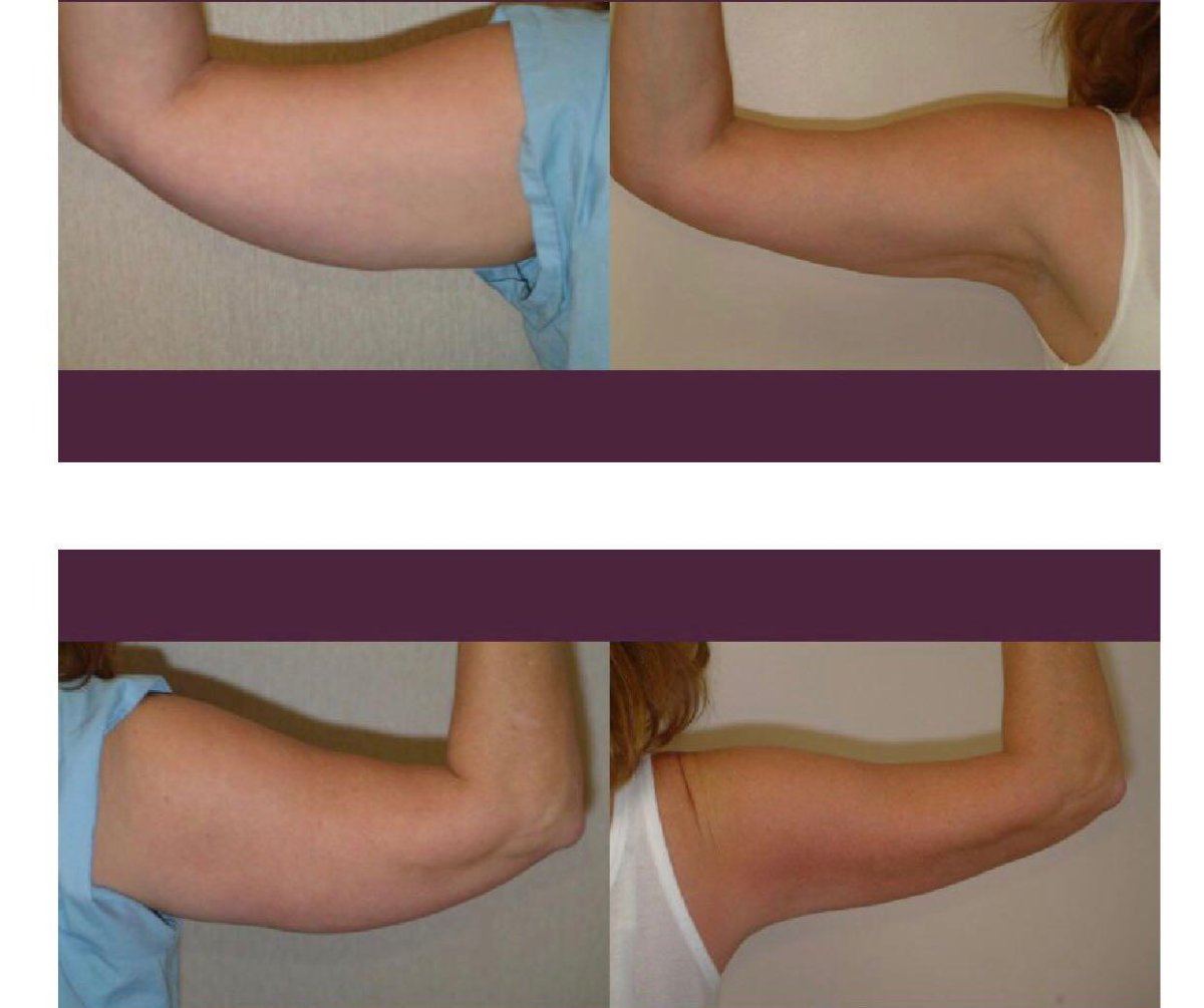 Resultados de lifting de brazos antes y después en Istanbul Aesthetic Plastic Surgery Center
