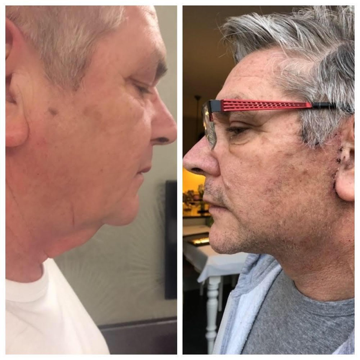 Resultados antes y después de lifting de cuello en Istanbul Aesthetic Plastic Surgery Center, mejor línea mandibular
