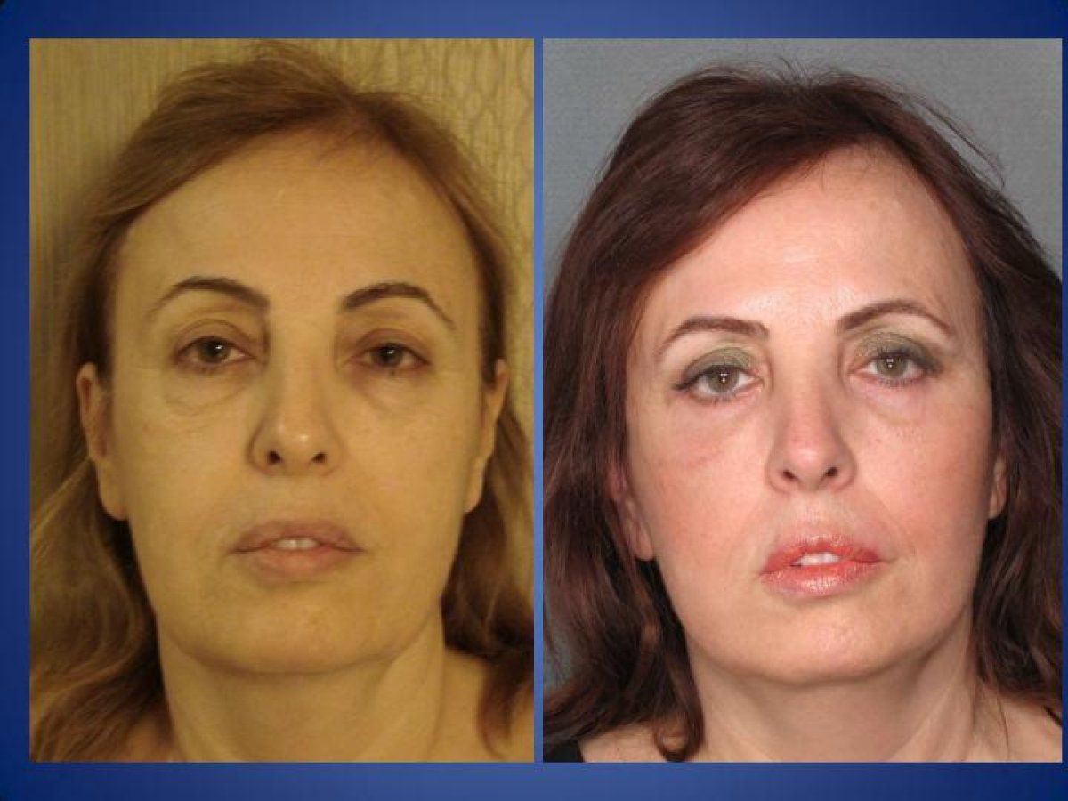 Resultados de lifting de cuello antes y después en Istanbul Aesthetic Plastic Surgery Center