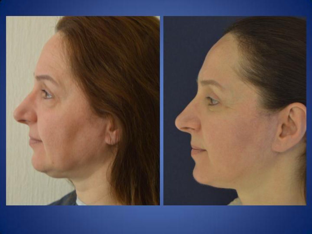 Efekty przed i po liftingu szyi w Istanbul Aesthetic Plastic Surgery Center, poprawiona linia żuchwy