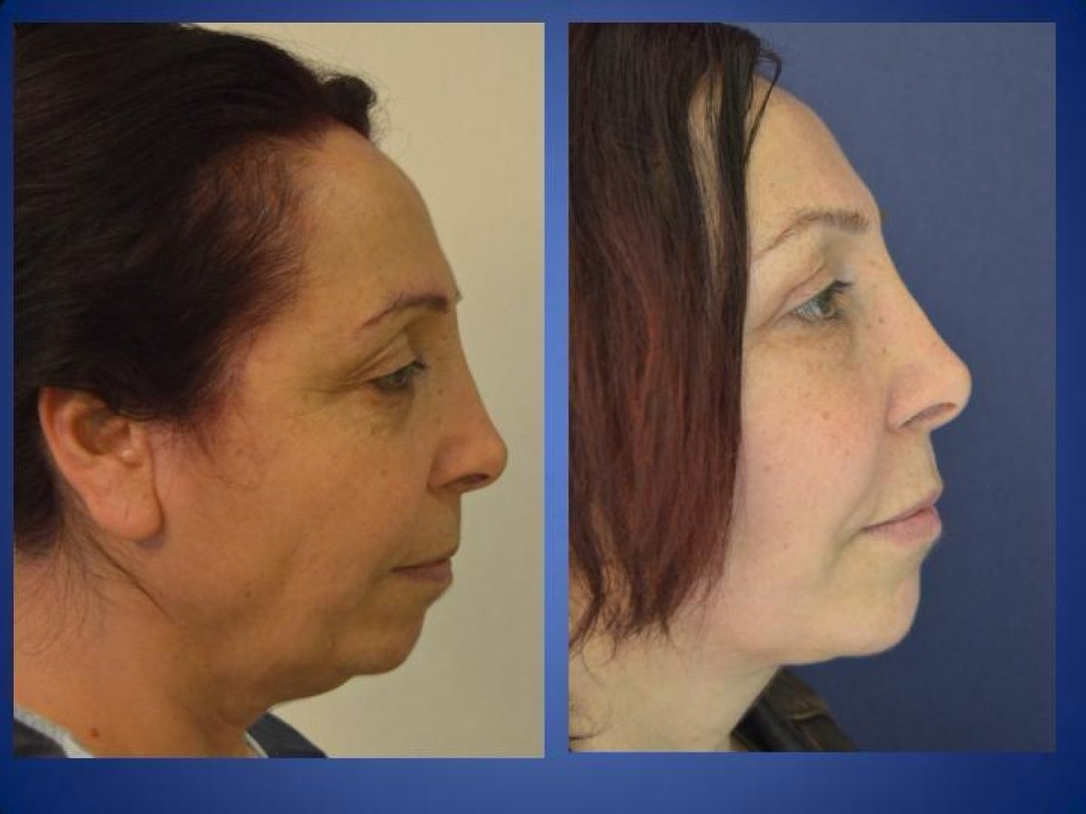 Resultados antes y después de lifting de cuello en Istanbul Aesthetic Plastic Surgery Center, mandíbula mejorada
