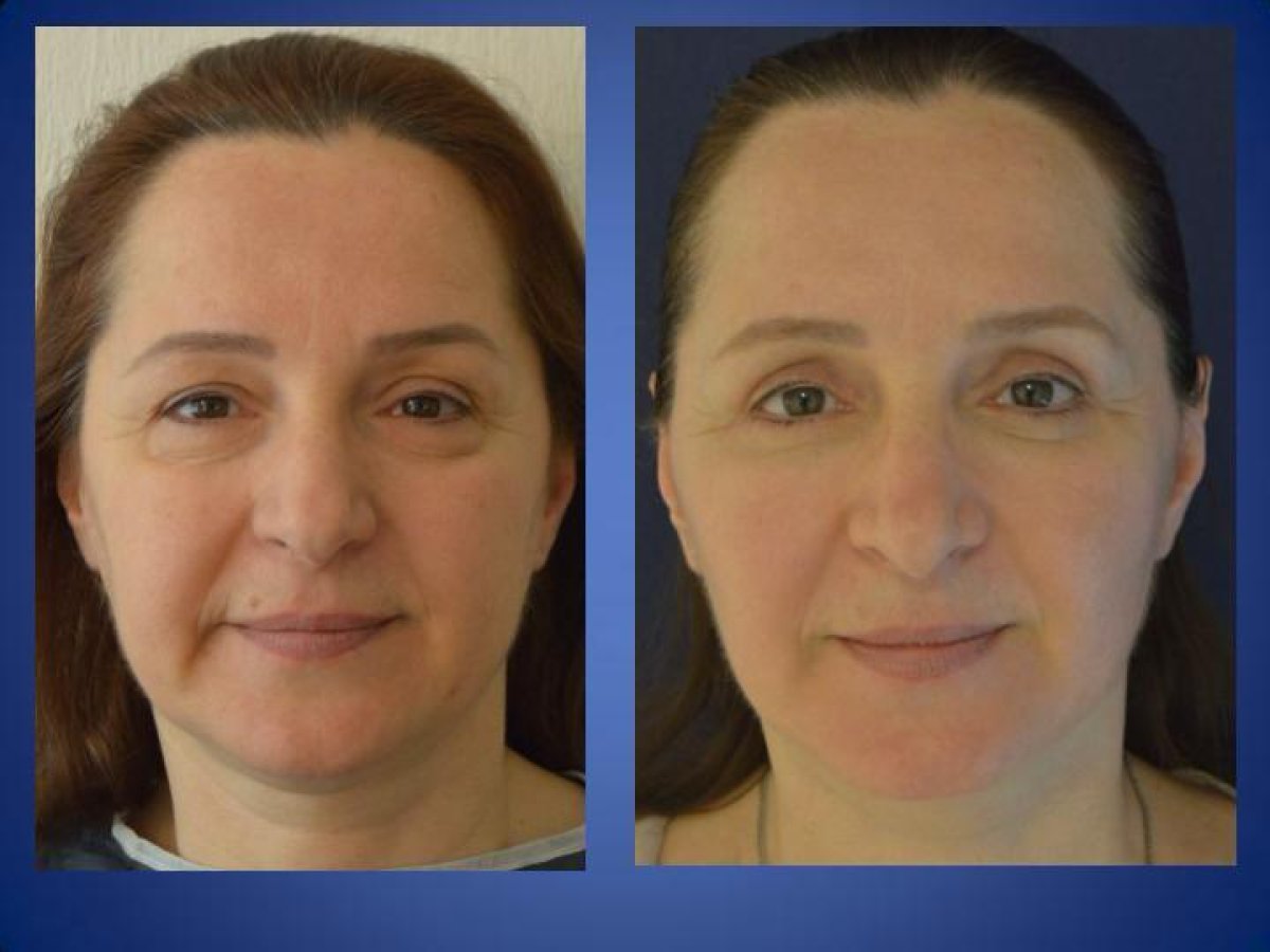 Resultados antes y después de lifting de cuello en Istanbul Aesthetic Plastic Surgery Center, rejuvenecimiento visible