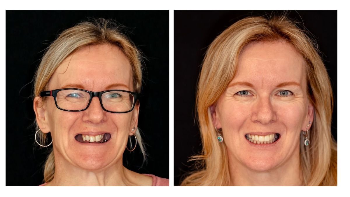 Before and after crown lengthening results at Smile Centrum – improved smile and gum line
