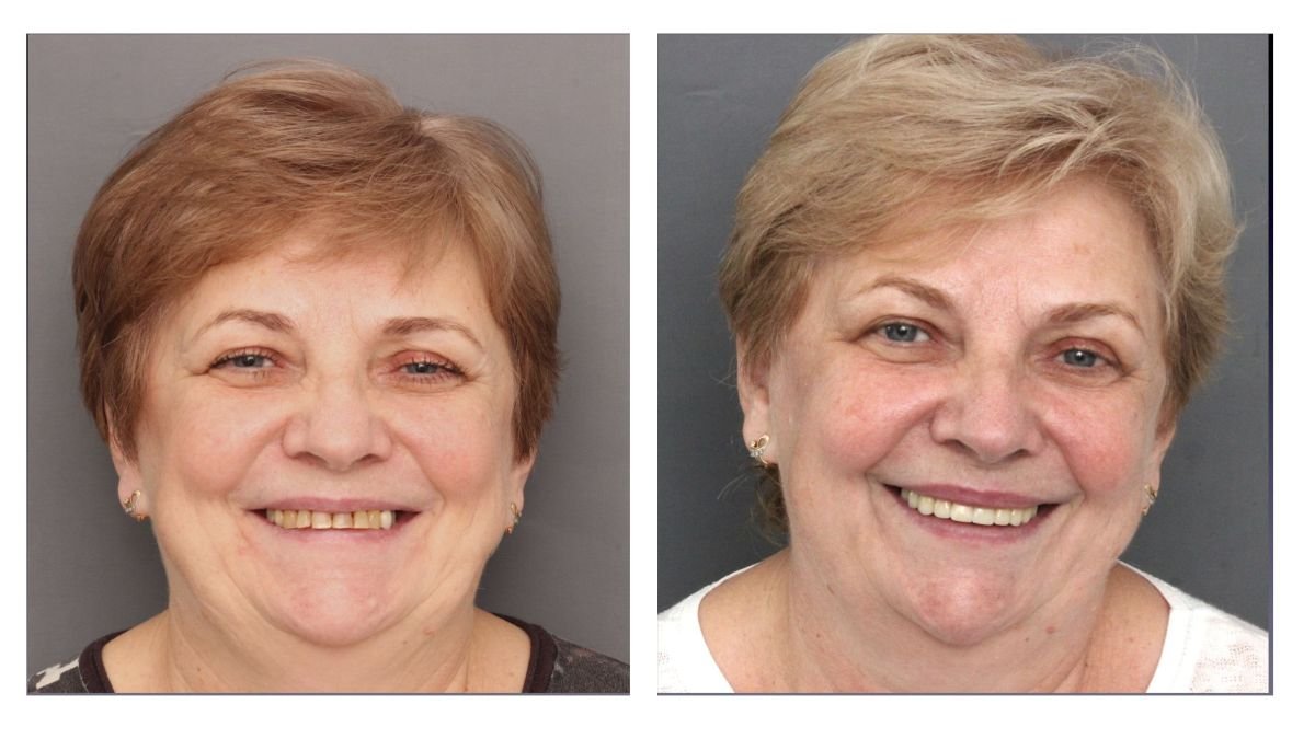 Before and after crown lengthening at Smile Centrum – improved gum line and smile result