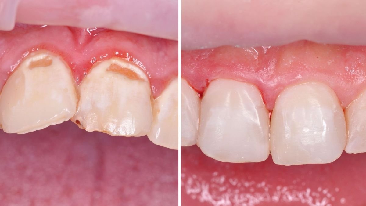 Antes y después de alargamiento de corona en Smile Centrum: mejora de encías y dientes