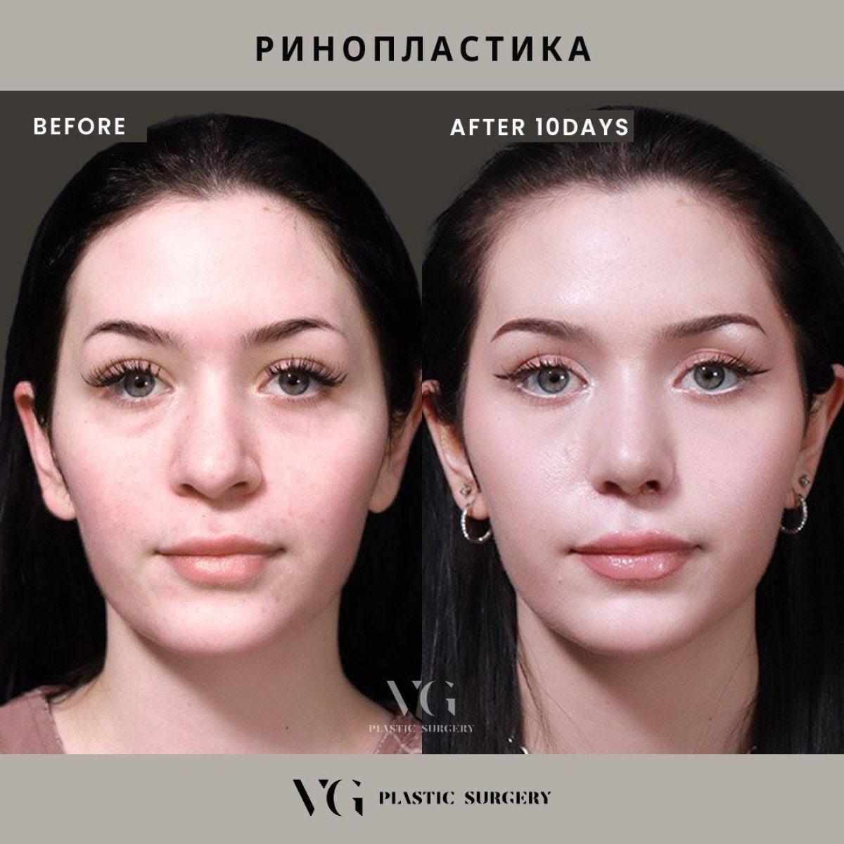 Vorher-nachher-Ergebnis der Nasenkorrektur bei VG Plastic Surgery, sichtbar nach 10 Tagen