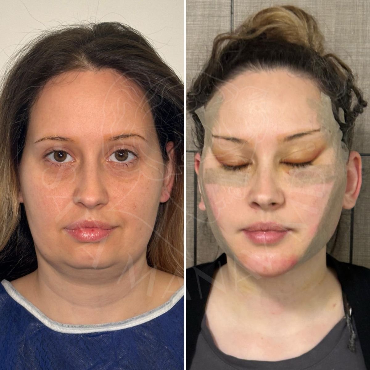 Resultados antes y después de extracción de grasa bucal en Dr. Safa Manav Clinic, contorno facial