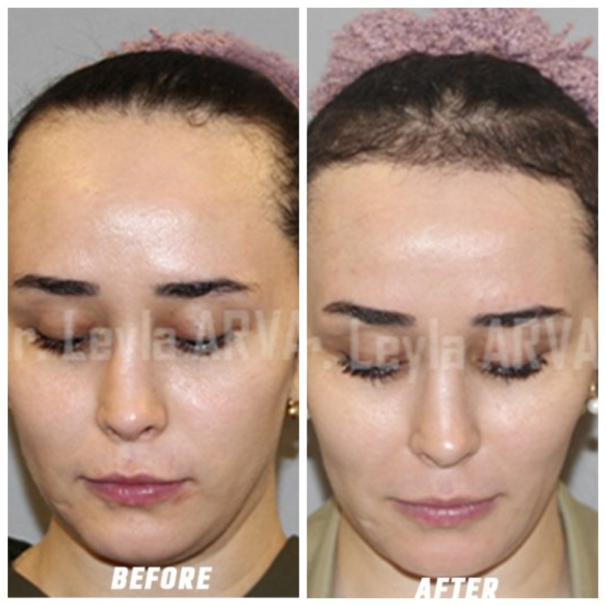 Before and after hair transplant results at Quartz Hospital, improved female hairline density
