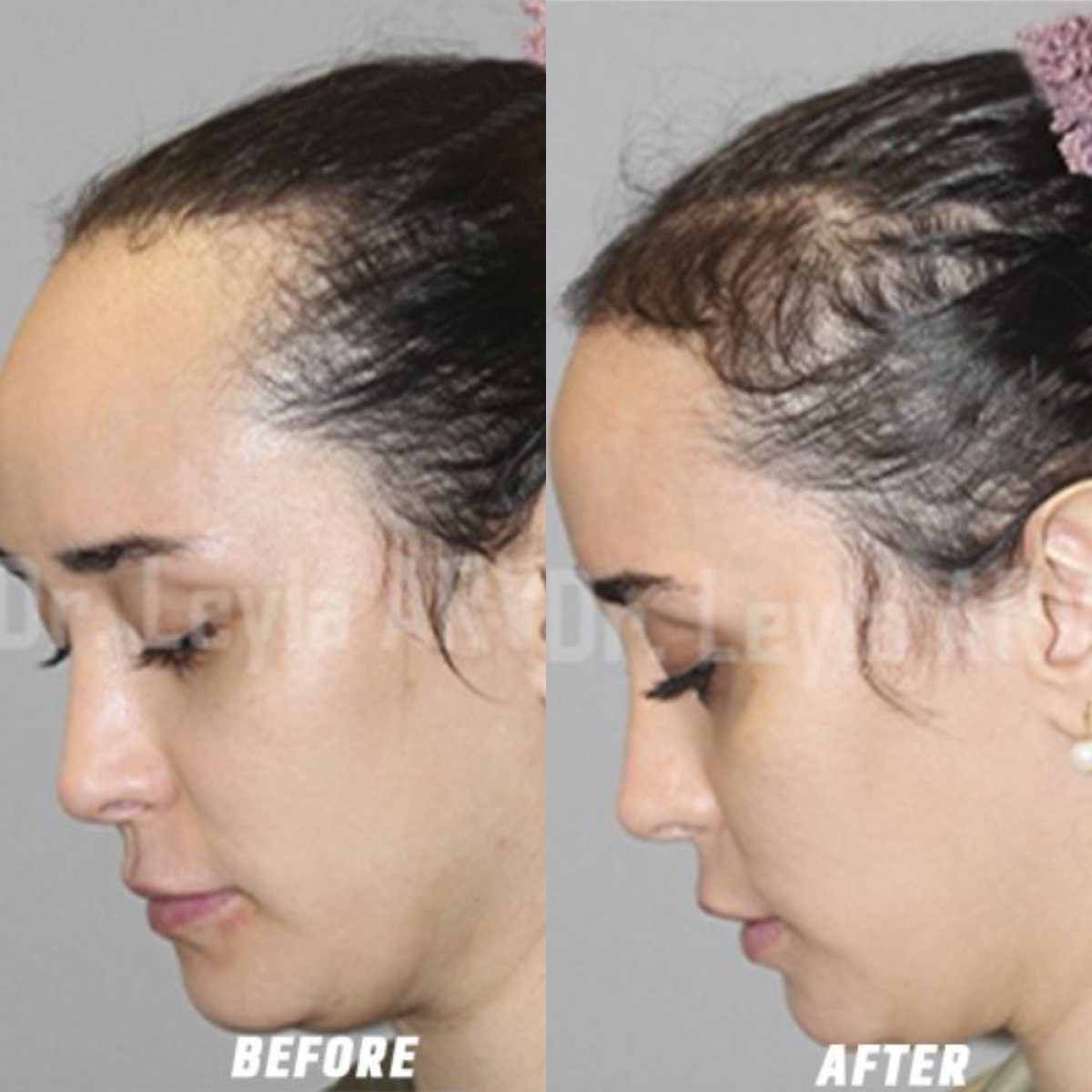Before and after hair transplant results for receding hairline at Quartz Hospital