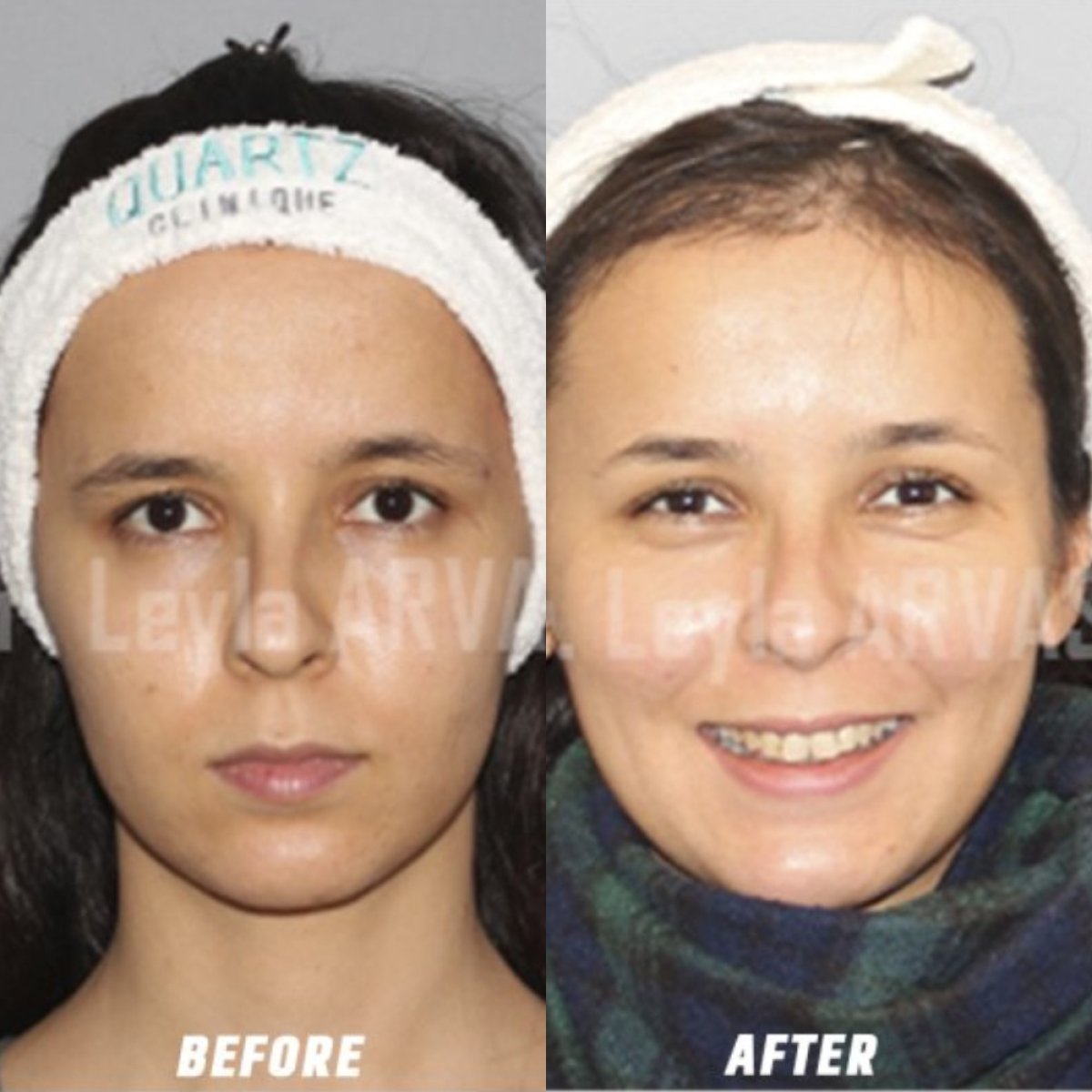 Before and after rhinoplasty results at Quartz Hospital, visible nose reshaping improvement