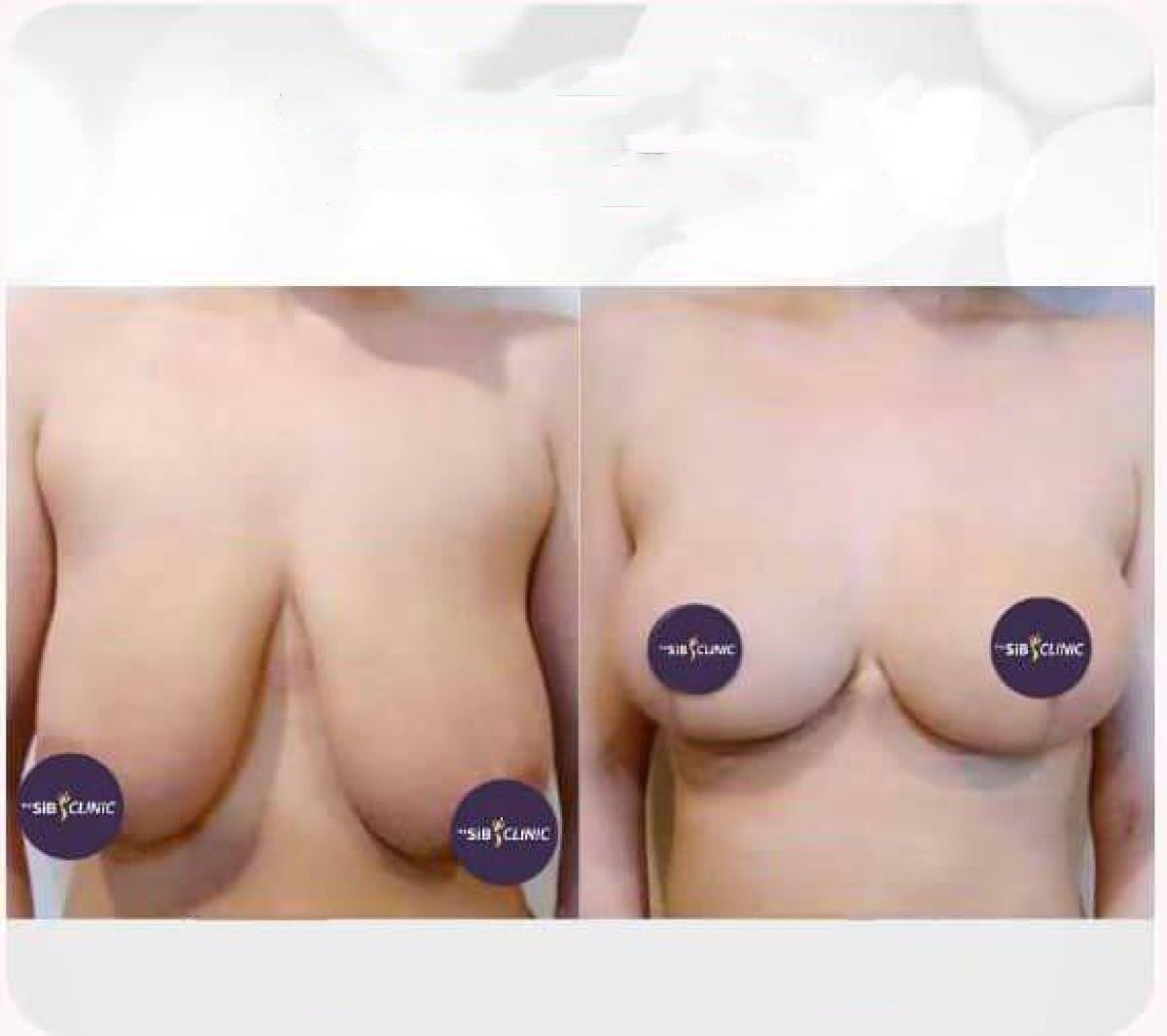 نتائج شد الثدي قبل وبعد في The SiB Plastic Surgery – تحسين شكل الثدي
